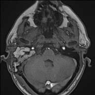 Post op MRI